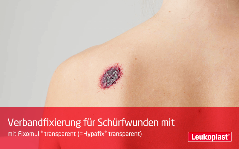 In diesem Video zeigen wir Ihnen die Behandlung einer   Schürfwunde mit Fixomull® transparent: Das Fachpersonal schneidet die gewünschte Größe zurecht und platziert den Verband auf der Schürfwunde der Patientin.  In diesem Video zeigen wir Ihnen die Behandlung einer   Schürfwunde mit Fixomull® transparent: Das Fachpersonal schneidet die gewünschte Größe zurecht und platziert den Verband auf der Schürfwunde der Patientin.